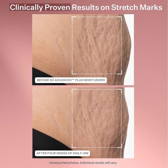 StriVectin SD Advanced Plus Intensive Moisturizer for Wrinkles and Stretch Marks - Picture 5 of 13